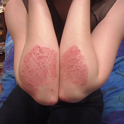 No More Psoriasis EVER!