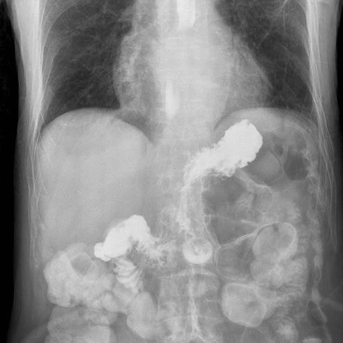 GERD X-ray - Melatonin
